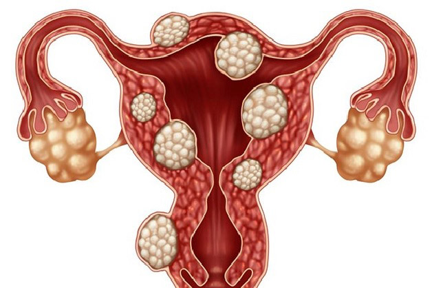U xơ tử cung đa nhân là tình trạng khối u phát triển với nhiều nhân xơ có đường kính khác nhau