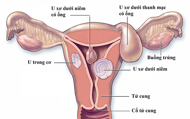 U xơ tử cung thoái hóa có thể được hiểu đơn giản là tình trạng khối u xơ không tiếp tục phát triển nhưng cũng không được loại bỏ