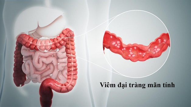 Viêm đại tràng mạn tính là bệnh lý phổ biến ở hệ tiêu hóa