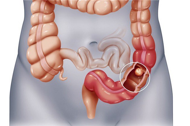 Ung thư đại tràng là biến chứng nguy hiểm nhất