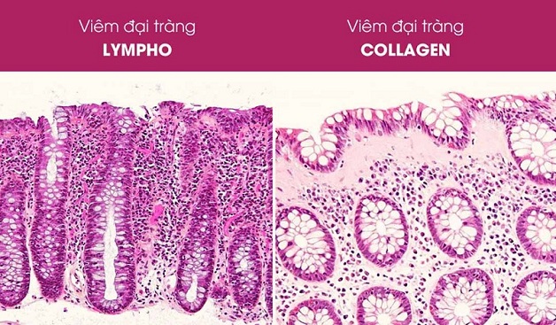 điều trị Viêm đại tràng vi thể