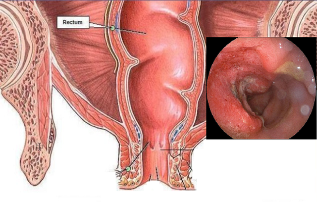 Viêm đại tràng vi thể triệu chứng