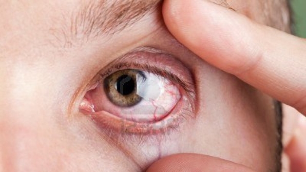 viêm mắt hột