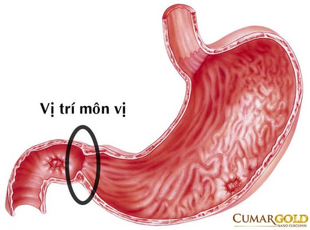 Viêm môn vị dạ dày là bệnh lý khá phổ biến ở hệ tiêu hóa