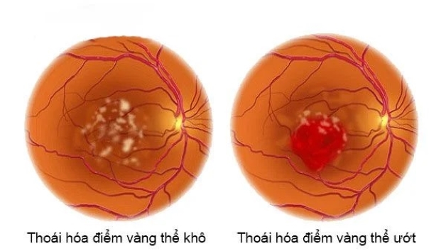 võng mạc thoái hóa