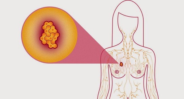 Xét nghiệm máu tầm soát ung thư vú
