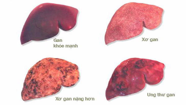 biểu hiện xơ gan ở người cao tuổi