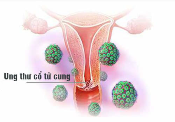 ung thư cổ tử cung giai đoạn đầu 