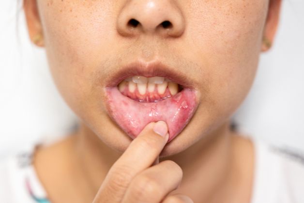 Dấu hiệu cho thấy bé bị viêm loét niêm mạc miệng.