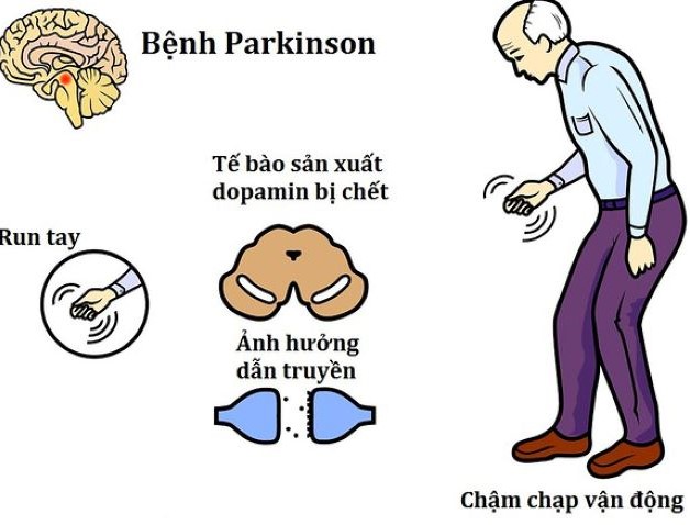 Biểu hiện điển hình của Parkinson