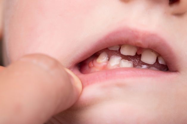 Khái niệm bệnh viêm chân răng ở trẻ em.