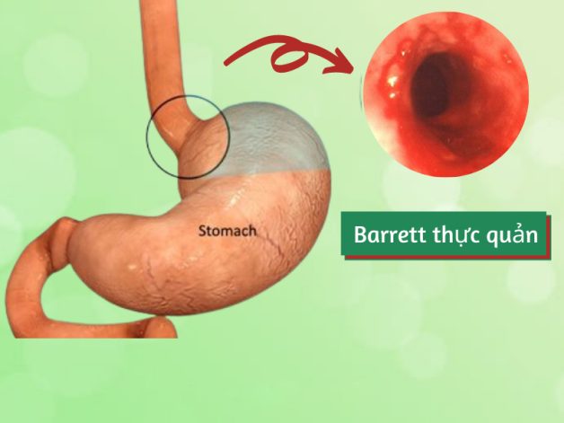 Trào ngược dạ dày lâu ngày biến chứng thành barret thực quản