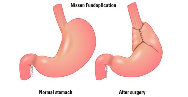 Mô phỏng thực quản sau phương pháp phẫu thuật Nissen