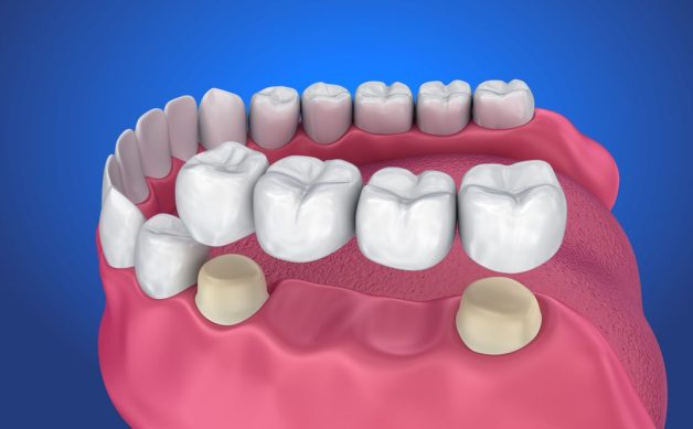 Lưu ý khi bọc và dán sứ Veneer. 