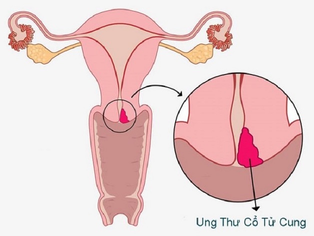 Tầm soát ung thư cổ tử cung