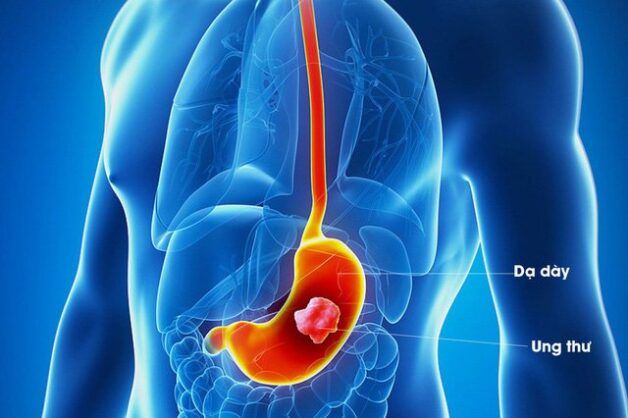 Ung thư dạ dày là căn bệnh nguy hiểm, nếu không phát hiện kịp thời thì nguy cơ tử vong sẽ cao hơn