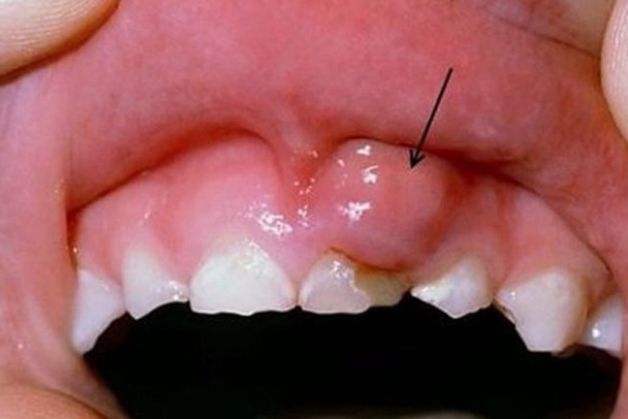 Dấu hiệu chân răng bị sưng mủ.
