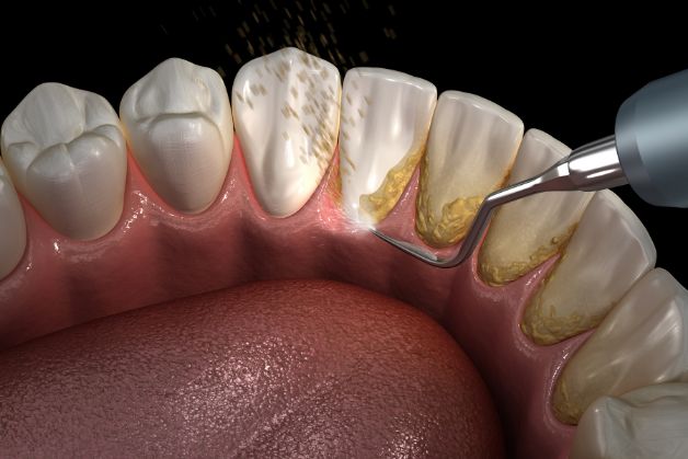 Điều trị thế nào khi chân răng bị sưng mủ?