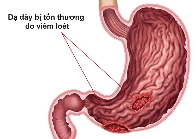 Viêm loét dạ dày là bệnh thường gặp ở hệ tiêu hóa