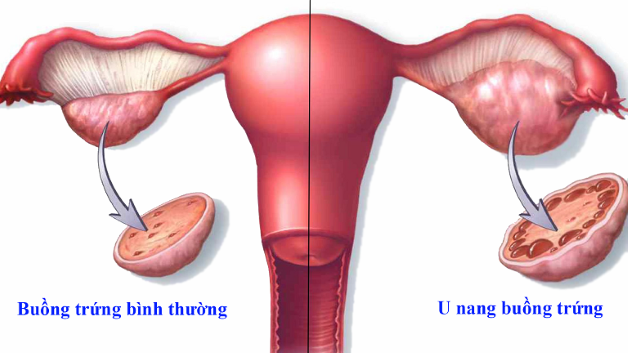Phần lớn u nang buồng trứng ở nữ giới đều lành tính và không gây nguy hiểm