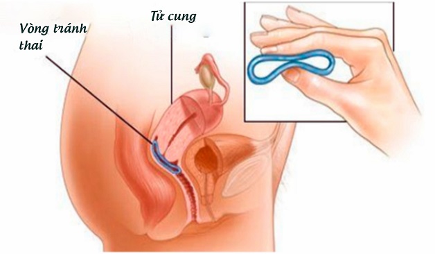 đặt vòng có dùng cốc nguyệt san được không