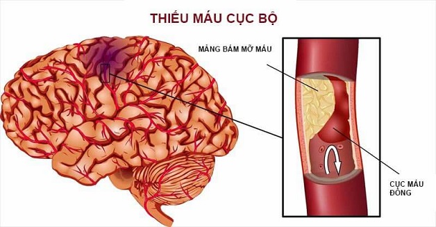 đau đầu vì thiếu ngủ lâu ngày do thiếu máu não