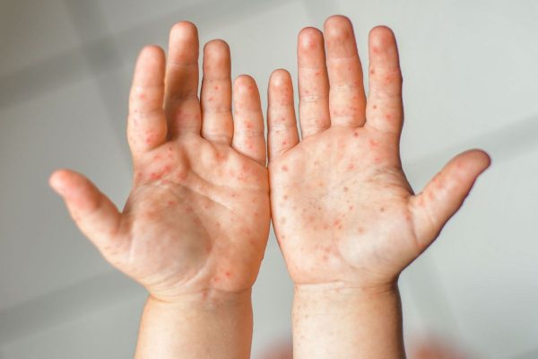 Tay chân miệng là bệnh truyền nhiễm do virus gây ra, thường gặp ở trẻ nhỏ