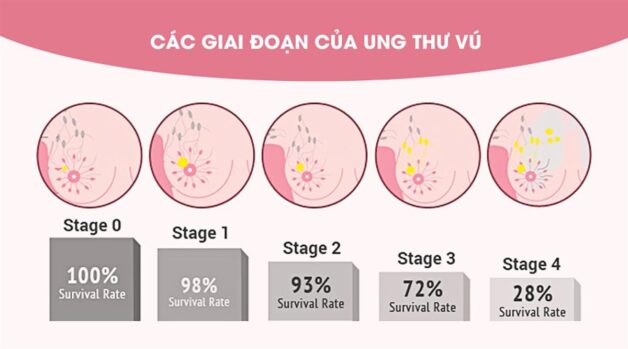 Các giai đoạn của ung thư vú