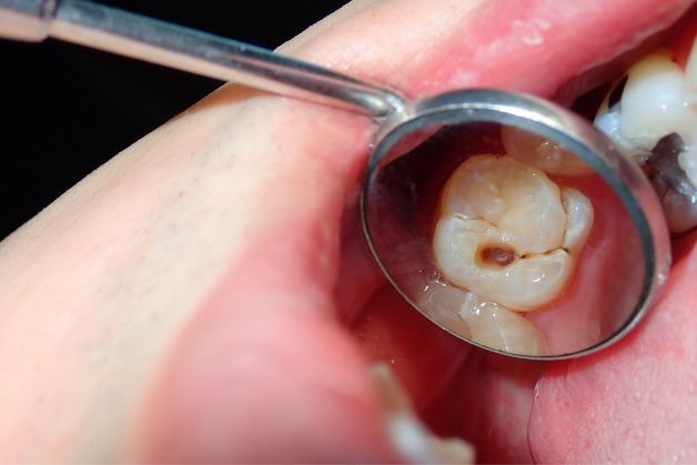 Có các phương pháp nào điều trị tuỷ răng cho bé?