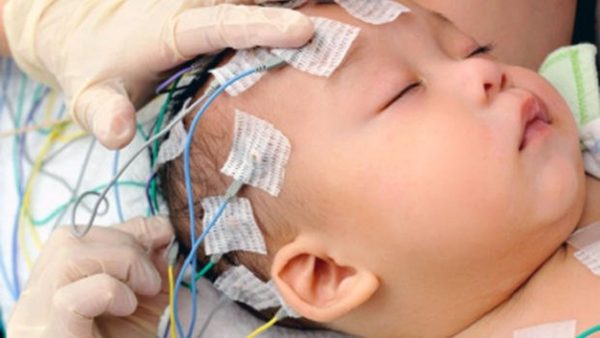 Đo điện não đồ kiểm tra động kinh ở trẻ em