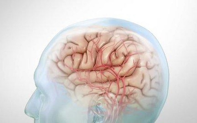 Hay bị đau nửa đầu do co thắt bất thường mạch não