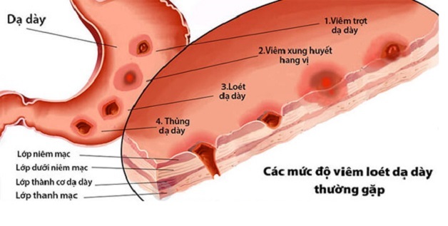 điều trị Loét nông dạ dày