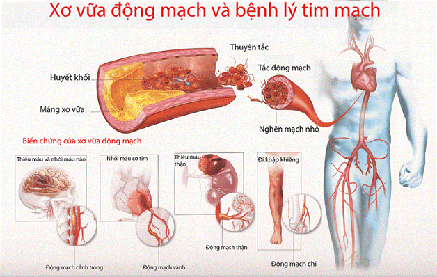 mất ngủ quá lâu gây nhồi máu cơ tim