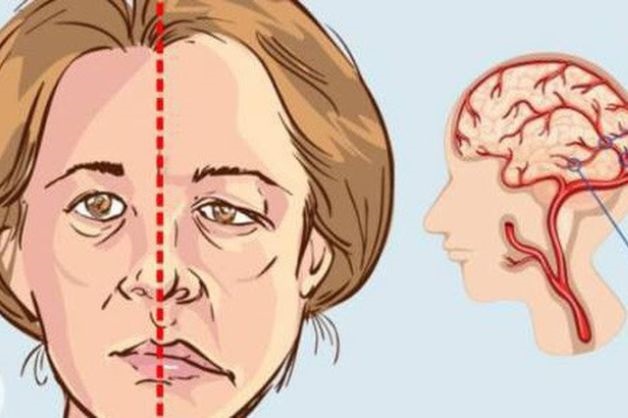 Mặt bị lệch sang một bên là một trong các biểu hiện của tai biến mạch máu não thường gặp
