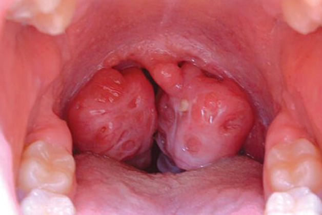 tầm soát ung thư vòm họng