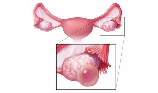 Nang nước xuất hiện tại buồng trứng như các túi dịch nằm dưới tai vòi trứng hoặc cạnh buồng trứng