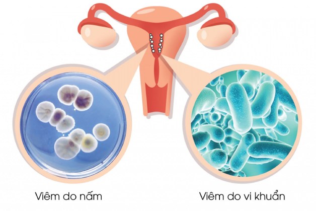 Viêm âm đạo biểu hiện nặng khi âm đạo nhiễm nấm