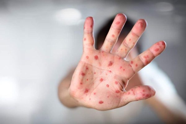 Tay chân miệng là bệnh lý phổ biến ở trẻ nhỏ do sức đề kháng của trẻ yếu, dễ nhiễm bệnh