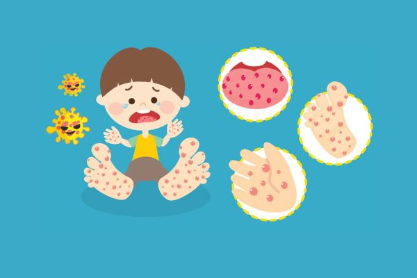 Trẻ mắc tay chân miệng sẽ có các nốt phỏng nước trên da kèm tình trạng sốt nhẹ, loét miệng...