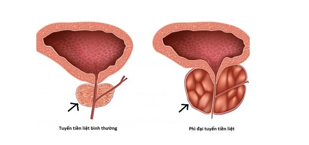 Tìm hiểu về bệnh lý sỏi bàng quang nguyên phát