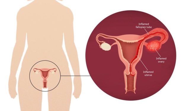  Giải đáp thắc mắc: Nữ bị quai bị có vô sinh không