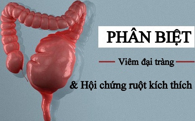 phân biệt hội chứng ruột kích thích và viêm đại tràng