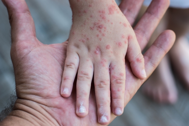 phản ứng sau tiêm sởi quai bị rubella là như thế nào