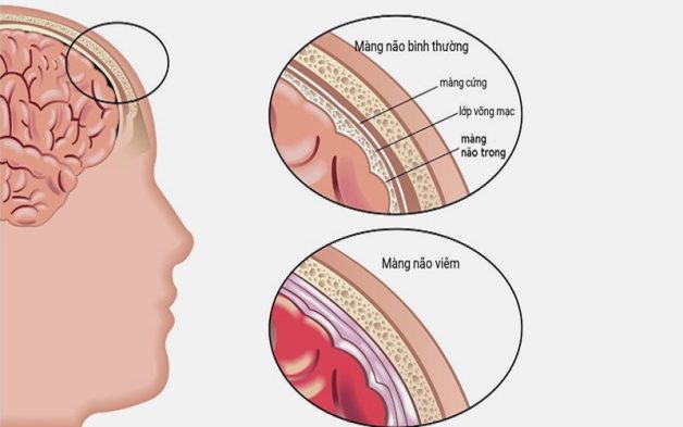 Viêm não là biến chứng nguy hiểm nhất của quai bị