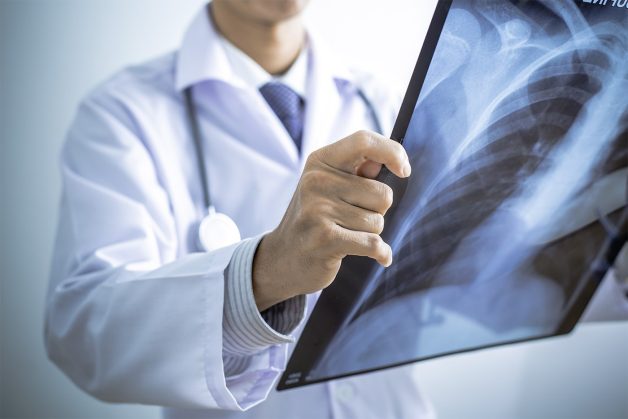 Quai bị có thể biến chứng đến viêm phổi