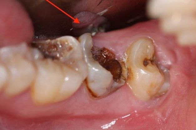 Vì sao răng số 7 bị sâu vỡ?