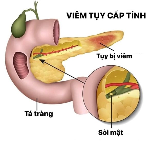 Rượu gây viêm tụy cấp ở cả nam và nữ, ở mọi lứa tuổi