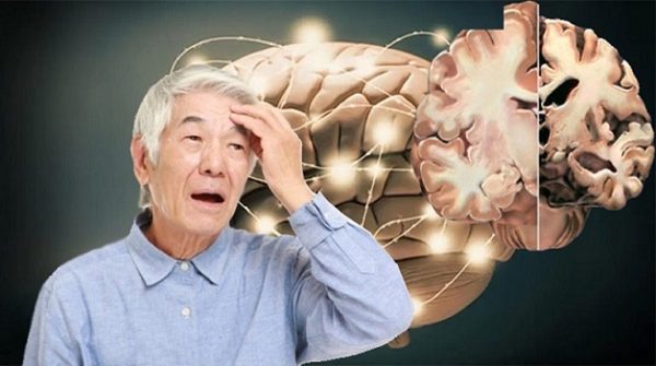 Sa sút trí tuệ khiến người bệnh không biết mình là ai