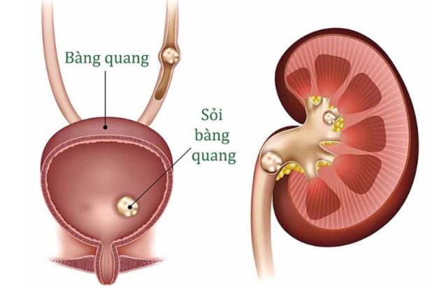 Nội soi tán sỏi bàng quang: Sạch nhanh, ít xâm lấn