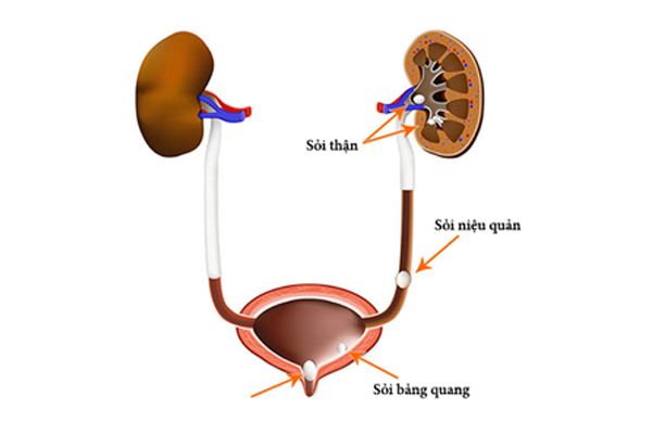 sỏi niệu quản đoạn sát thành bàng quang